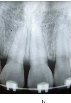 Gambar 9. Contoh perbandingan foto yang diambil dari pasien yang sama, (a) foto panoramik diambil sebelum pemakaian piranti ortodonti cekat tanggal 18 Januari 2011 dan (b) foto periapikal diambil setelah pemakaian piranti ortodonti cekat tanggal 30 November 2013 