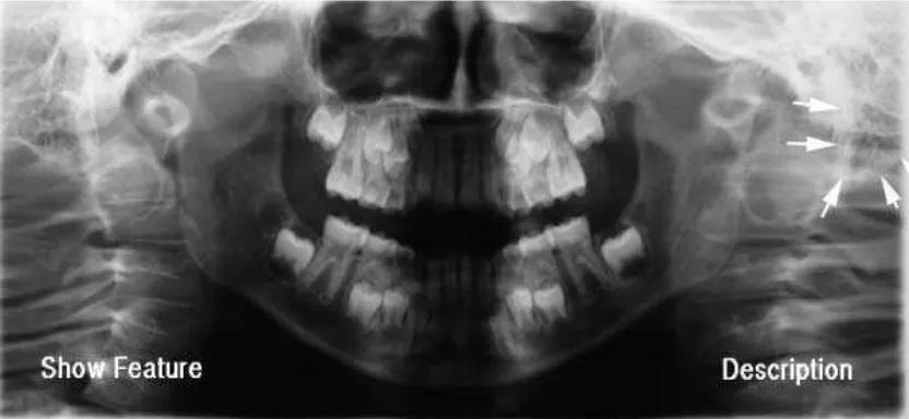 Gambar 4.Prosesus mastoid pada gambaran radiografi panoramik14 