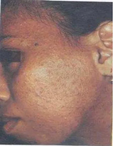 Gambar 2.2 Akne kosmetika. Tampak papula-papula akibat sifat komedogenik pembersih muka 