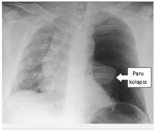 Gambar 2. Gambaran radiologi Pneumothorak ventil dikutip dari 1