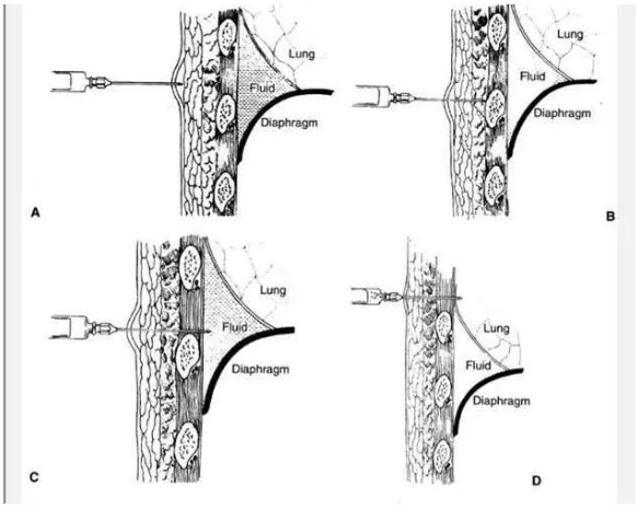 Gambar 4. Gambaran otot, syaraf, pembuluh darah serta vena pada ruang interkostal.Dikutip dari 2 