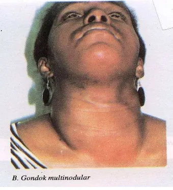 Gambar 3. Penonjolan Mata (eksoftalmus) pada hipertiroid (graves disease) 