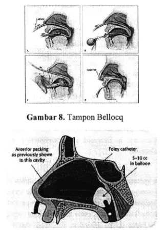 Gambar 8. Tampon Bellocq