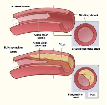 Gambar 1. Atherosklerosis ( National Heart, Lung and Blood Institute, 2015)