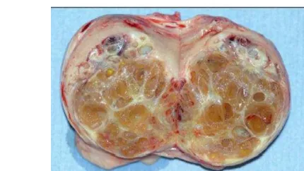 Gambar 3    Granulosa-theca cell tumor (GTCT) (McAullife 2013) 