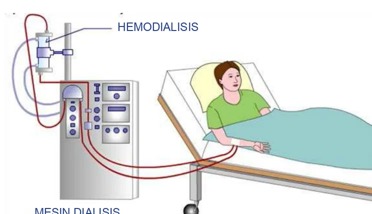 Gambar di atas menunjukkan proses cuci darah (hemodialisis) pada penderita gagal ginjal