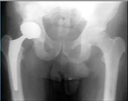 Figure 2.2: Hip Joint Prosthesis on Human Skeleton (Orthodoctor.com) 