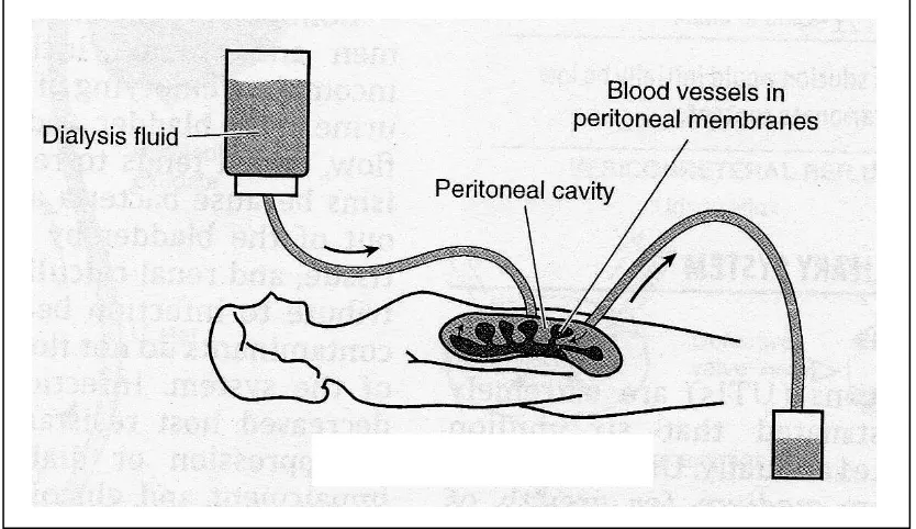 Gambar 3. Proses dialisis peritoneal25 