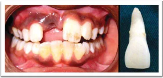 Gambar 1. Gambar intraoral gigi yang mengalami avulsi  18  