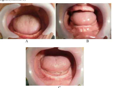 Gambar 5.  Foto posisi lidah pasien edentulus penuh Klinik Prostodonsia RSGMP FKG USU tahun 2014 A