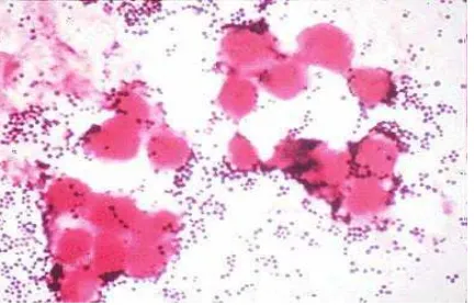 Gambar 2. Gram stain Staphylococcus aureus diambil dari eksudat pustula (Todar,2005) 