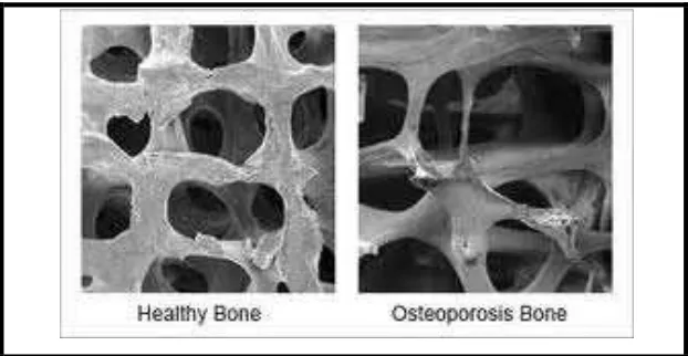 Gambar 4. Gambaran Mikroskopis Tulang Normal dan Osteoporosis 