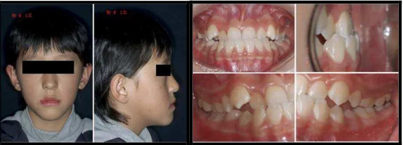 Gambar 5. Crossbite anterior dental27