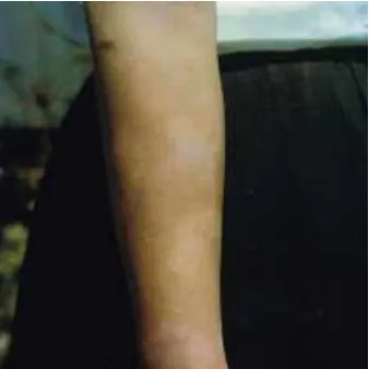 Gambar 2.6. Dermatitis seboroik (Sumber: Sasakawa Memorial Health Foundation, Tokyo, 2005) 
