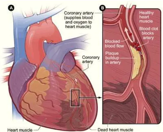 Gambar 1 Myocardial infarction: (A) jantung yang mengalami kerusakan cardiomyocyte dan (B) penyempitan pembuluh darah arteri yang menyebabkan kerusakan cardiomyocyte  (NHLBI 2008)