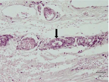 Gambar 1. Metastase sel-sel tumor dari Mix Malignant kelenjar mammae ditemukan adanya sel tumor pada pembuluh darah (H&E, 400x), ditandai dengan satu atau dua lapis otot polos
