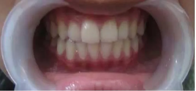 Gambar 6. Cheek retractor dipasang di mulut subjek dan difoto. 