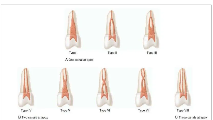 Gambar 5. Klasifikasi saluran akar menurut Vertucci11 
