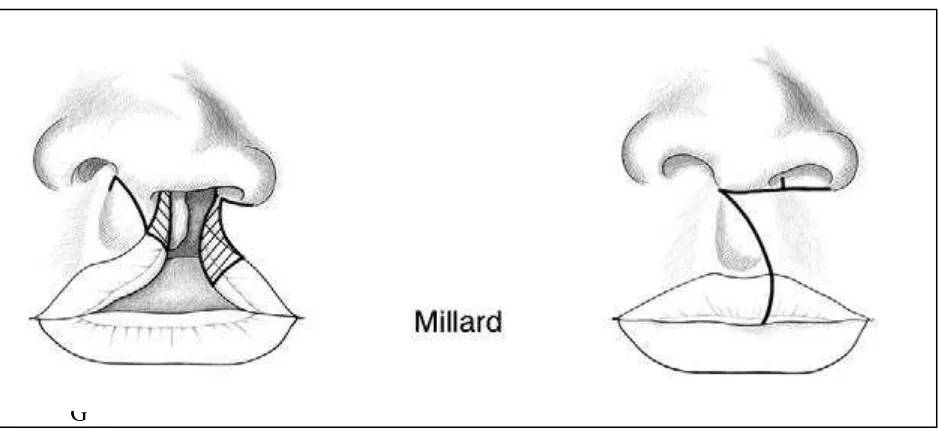 Gambar 9. Desain rekonstruksi celah bibir metode Millard. (Demke, JC., Tatum CA. Analysis and evolution of rotation principles in unilateral cleft lip repair
