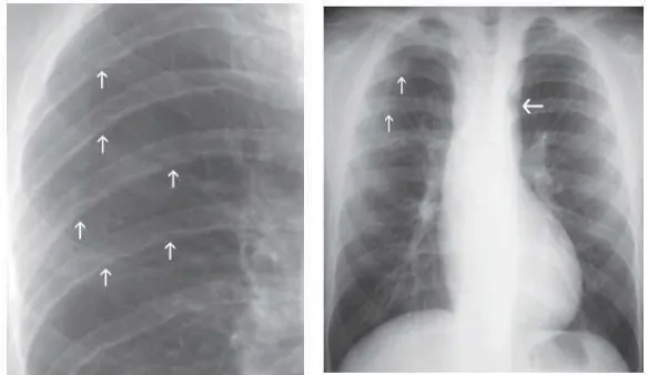 Gambar 3. Gambaran Radiologis Koartasio aorta