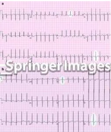Gambar 4. EKG pada neonates dengan koartasio aorta.