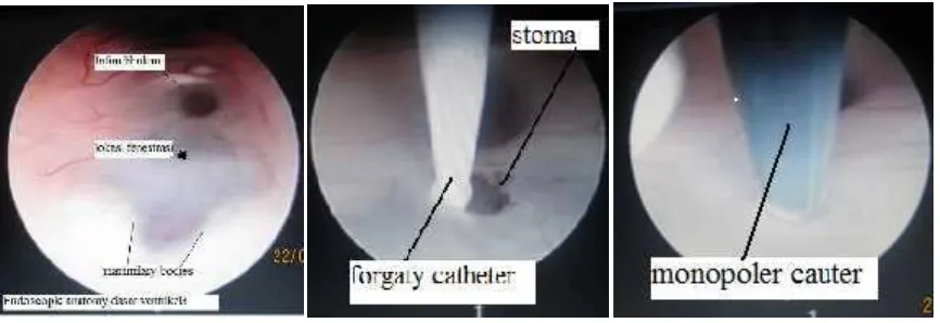 Figure 1. Endoscopic Third Ventriculostomy procedure.