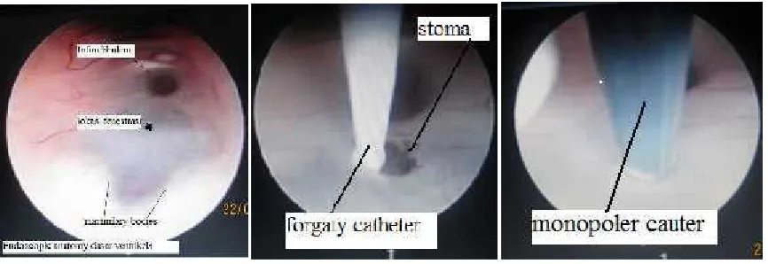 Figure 1. Endoscopic Third Ventriculostomy procedure.