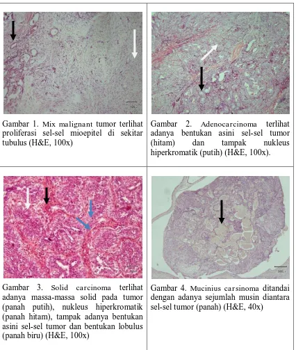 Gambar 1. Mix malignant tumor terlihat proliferasi sel-sel mioepitel di sekitar 