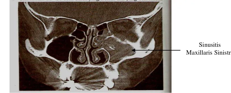 Gambar 2.8  CT-Scan sinus yang bersih dan yang tersumbat (Sumber: Metson 