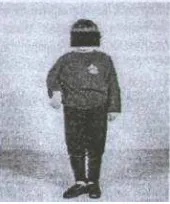 Gambar 1. Monoplegia pada lengan kanan atas2