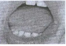 Gambar 2. Self•Multilation pada bibir dan lidah2