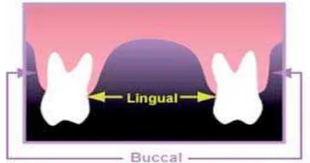 Gambar 1. Titik referensi dalam pengukuran lebar  intermolar pada daerah bukal dan lingual.7,20 