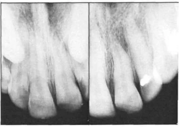 Gambar 4. Gambaran gigi incisivus sentral yang dilakukan 