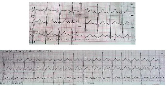 Gambar 1.EKG pasien menunjukkan sinus takikardia, LAD, LAE, dan LVH voltage