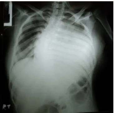 Gambar 2. Gambaran foto ronsen thorax AP menunjukkan kardiomegali dan skoliosis