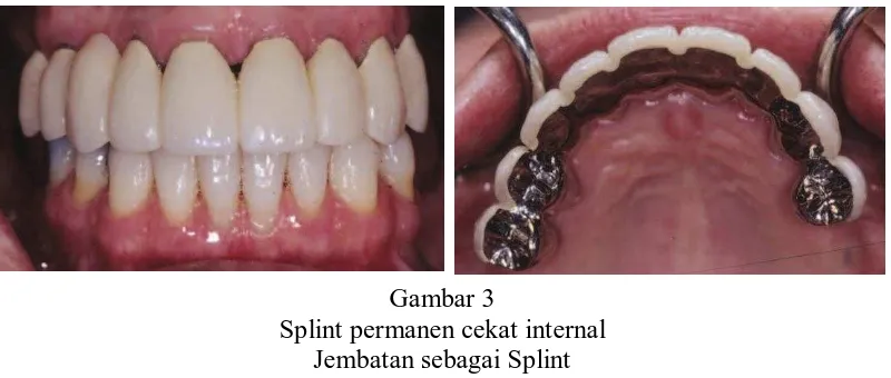 Gambar 3 Splint permanen cekat internal 