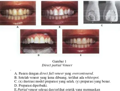        Gambar 1    Direct partial Veneer