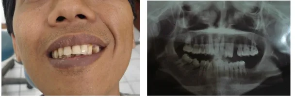 Gambar 1. Foto klinis dan foto rontgen pasien 1 sebelum perawatan
