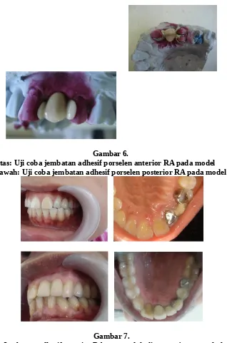 Gambar 6. Atas: Uji coba jembatan adhesif porselen anterior RA pada model