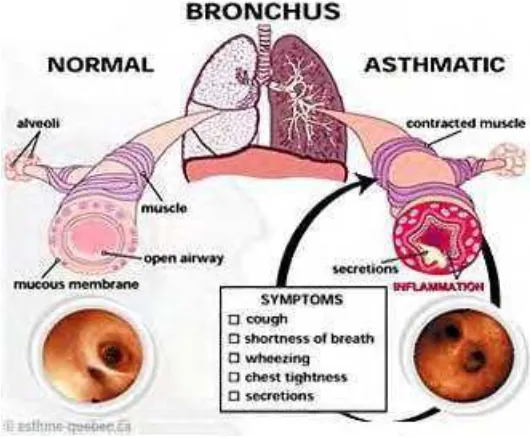 Gambar 1    Skema bronkhokonstriksi pada penderita asma (Anonimous 2008a) 