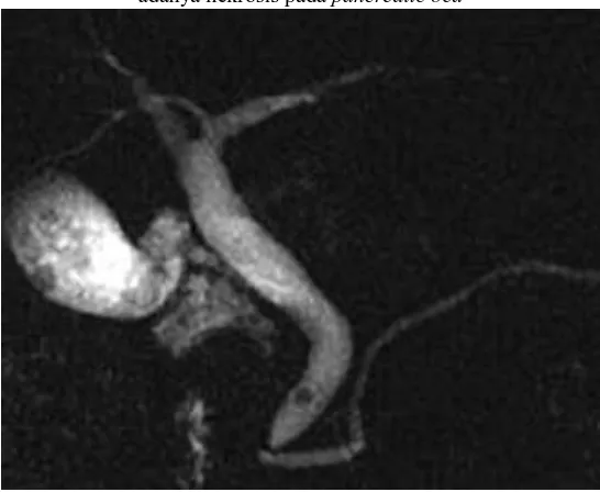 Gambar 9. Gambran MRCP pada pasien severe acute pancreatitis menunjukkan adanya nekrosis pada pancreatic bed 