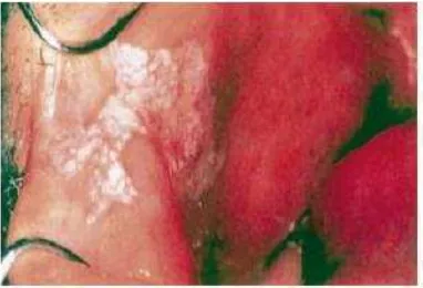 Gambar 7 : Gambaran klinis Median Romboid Glossitis 