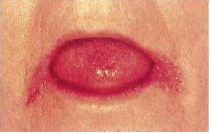 Gambar 8 : Gambaran klinis Angular Cheilitis (Akpan and Morgan, 2002). 