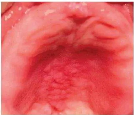 Gambar 9 : Gambaran klinis Kandidiasis Eritematosa atau denture 