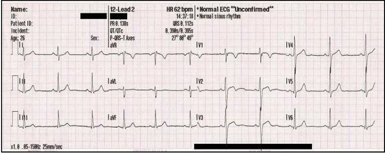 Figure 1.1 Example of 12 Lead ECG of a 26 year old male [1]