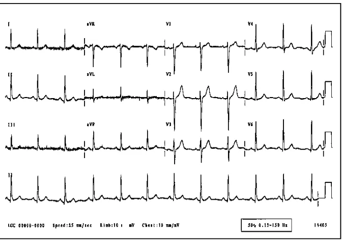 Figure 2.1 Schematic Representation of Normal ECG [1] 