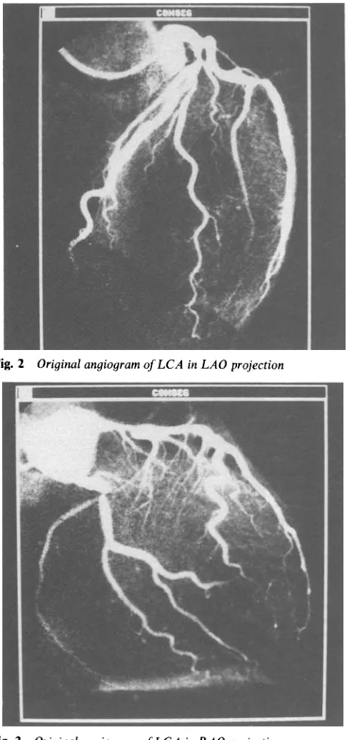 Fig. 2 Original angiogram of LCA in LAO projection 
