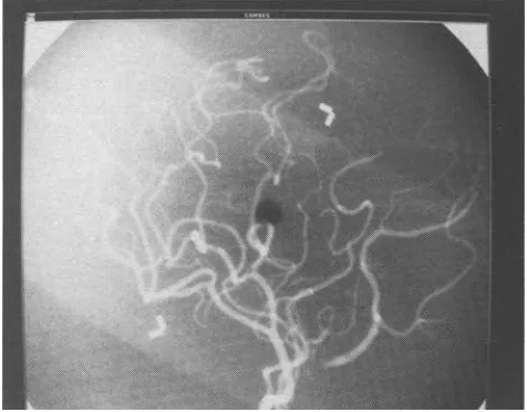 Fig. 5 Original angiogram of the cerebral blood vessel phantom, the projection angle differs 9~ that of Fig