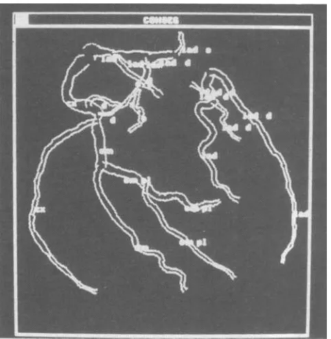 Fig. 8 Modet for the relationship "above" in RAO and LAO projection 