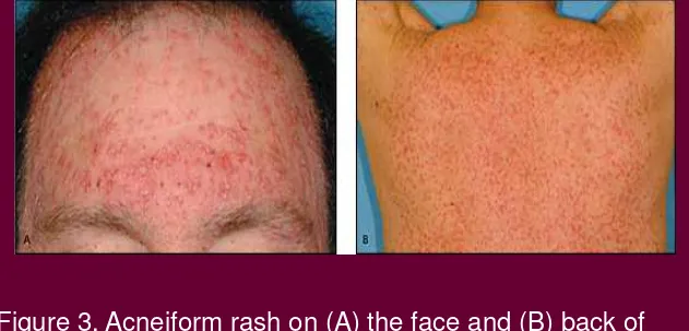 Figure 3. Acneiform rash on (A) the face and (B) back of 